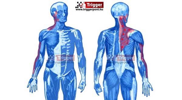 trapezius - vállöv hát trigger pont